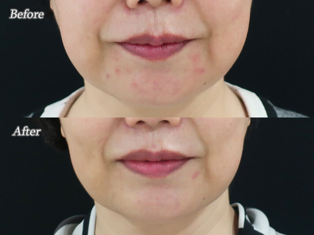 ギュッと口を閉じる癖にはボトックス 美容皮膚科女医のブログ ギュッと口を閉じる癖にはボトックス 美容皮膚科女医のブログ