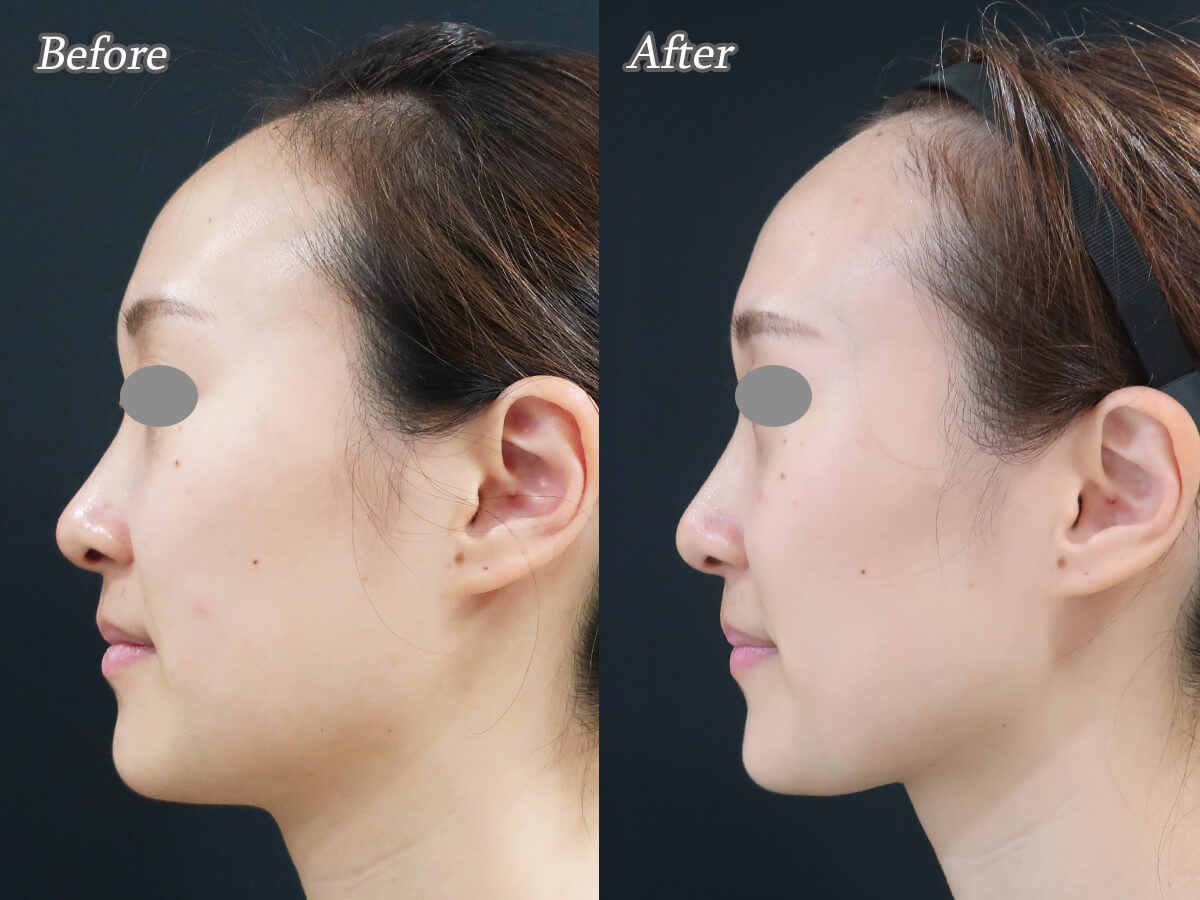 顎のボトックスによるフェイスラインの変化 | 美容皮膚科女医のブログ