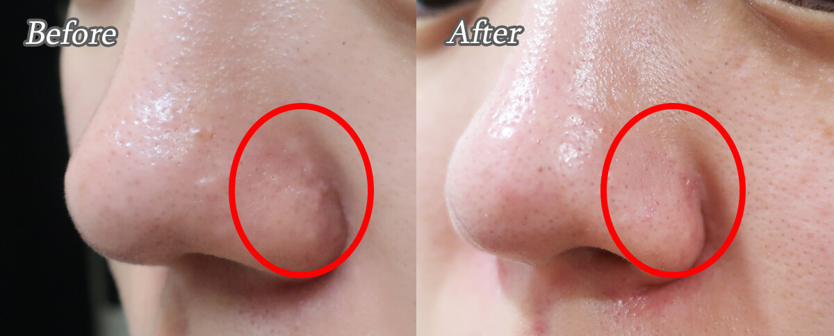 鼻にできた脂腺増殖症もアグネスでレーザー治療