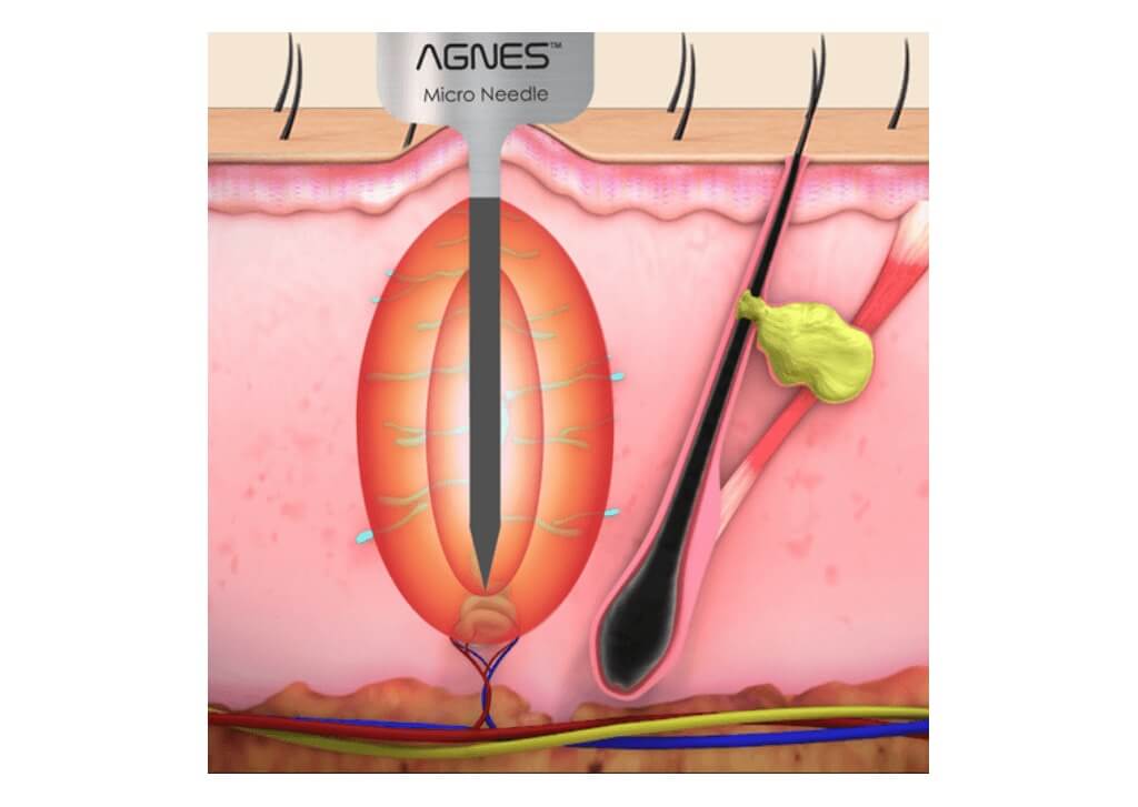 アグネスAGNESによる脂腺増殖症イボレーザー治療