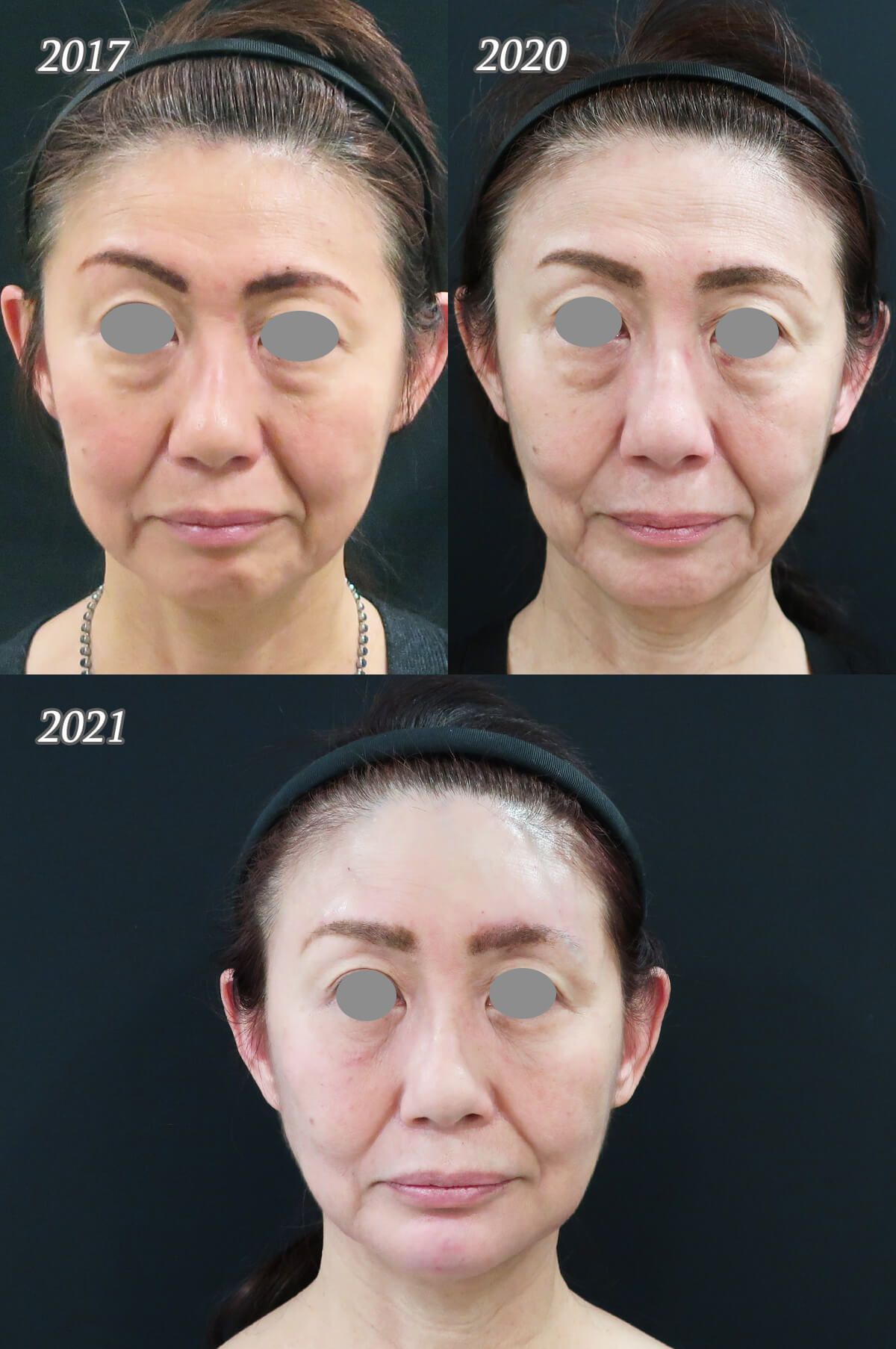ヒアルロン酸リフトで首も若返る | 美容皮膚科女医のブログ
