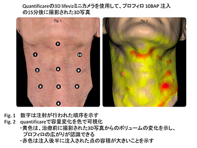 首に注射したプロファイロの広がる様子