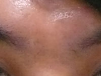 眉間のしわ！ - 東京 渋谷 美容皮膚科 マグノリア皮膚科クリニック