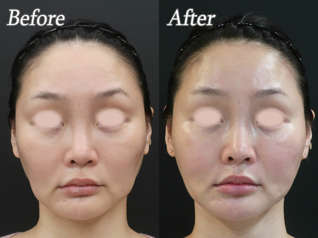 引っ張る糸、支えるヒアルロン酸