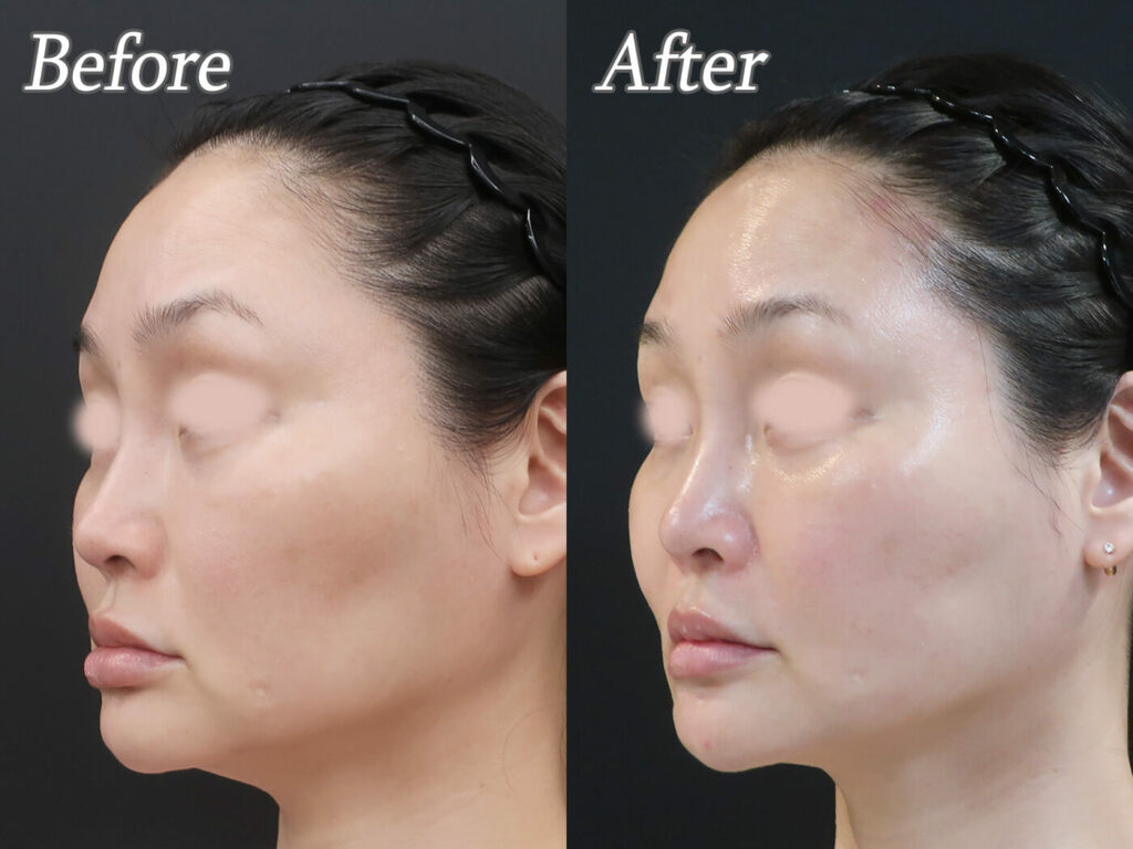 1Dayリフトの症例写真