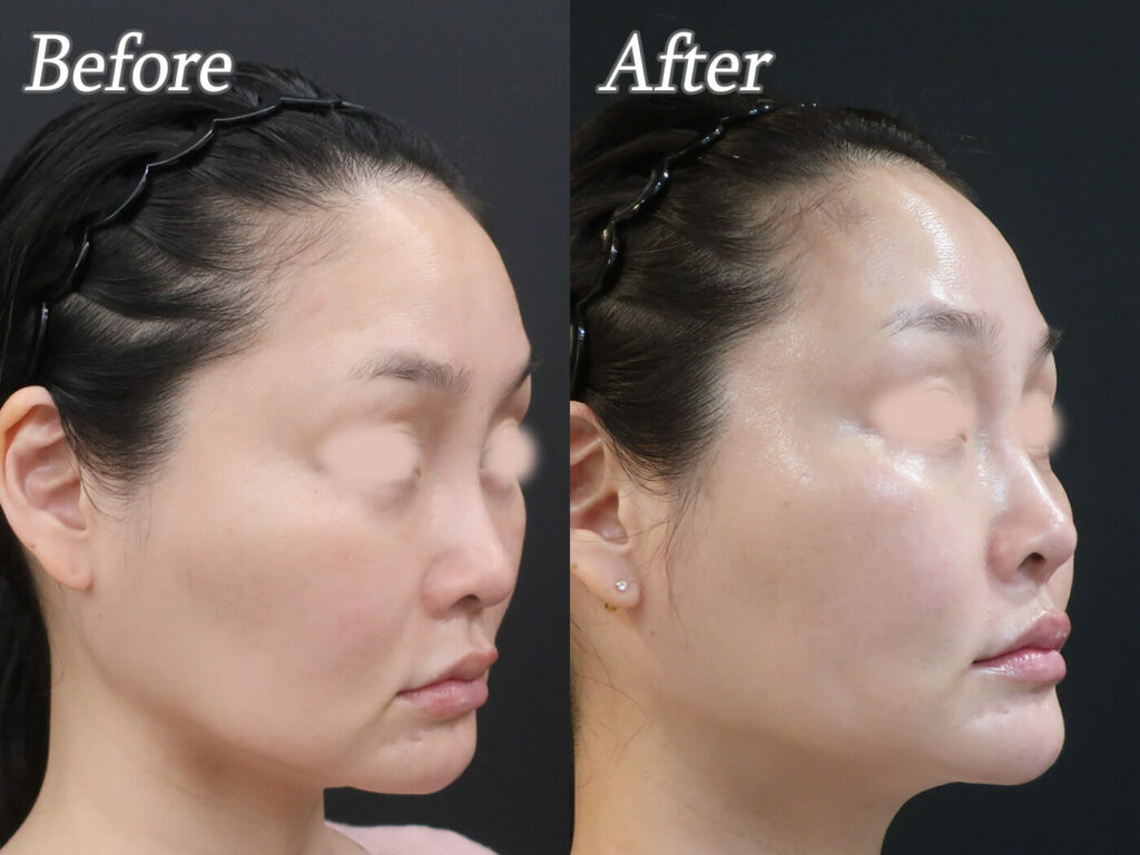 1Dayリフトの症例写真