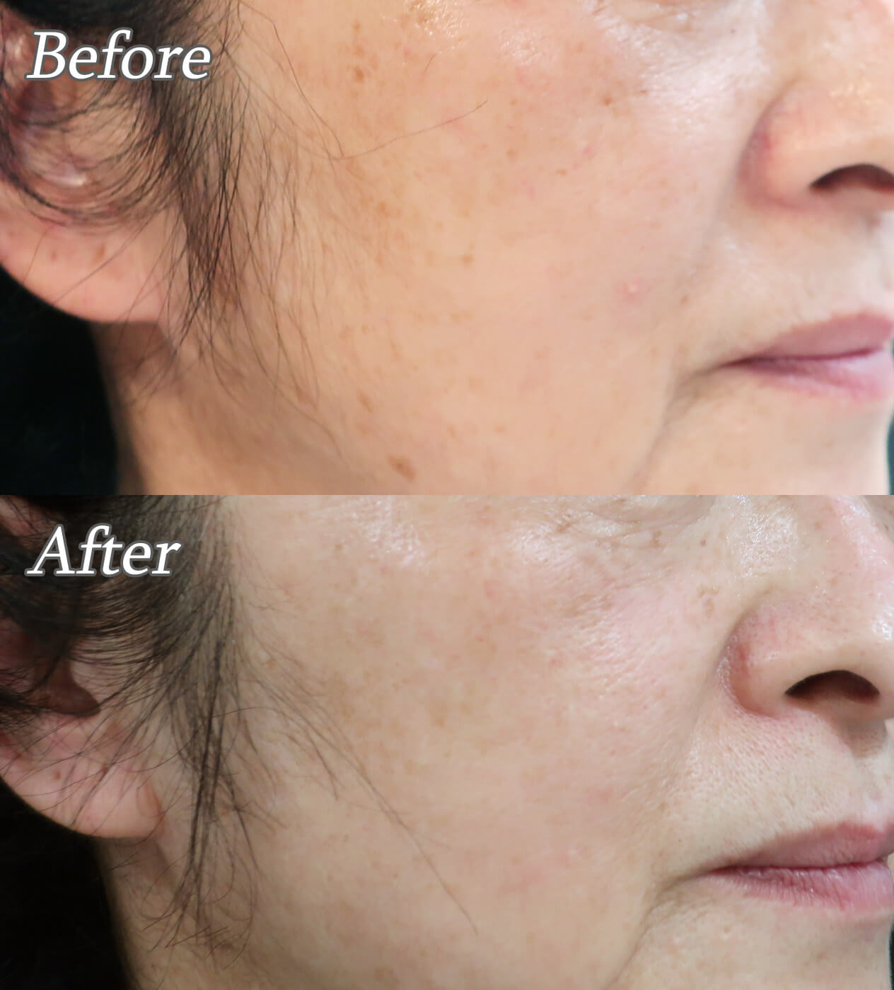 レーザートーニング＋ジェネシス＋シミ治療