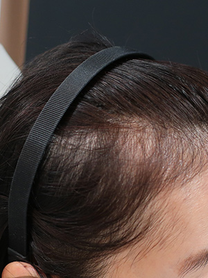 女性の薄毛治療エクソソーム頭皮注射