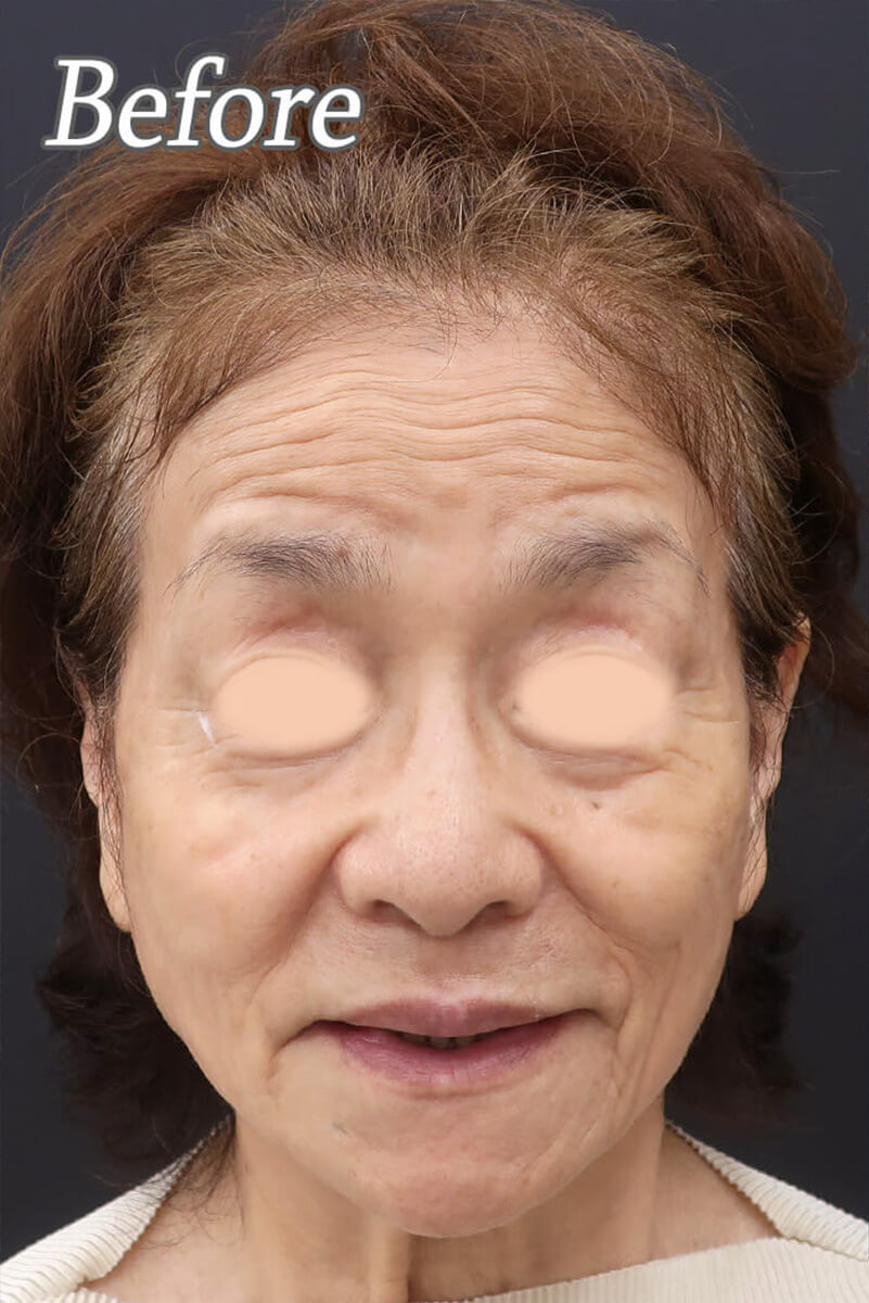 before写真
