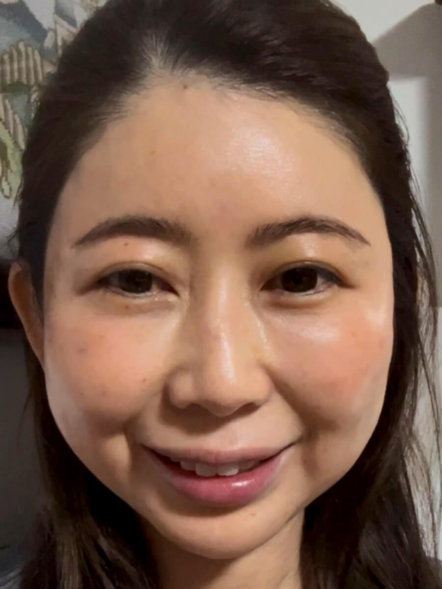 勇気を出して綺麗になるはじめの一歩　「他院修正（ヒアルロニダーゼ）」　衝撃的な私の顔