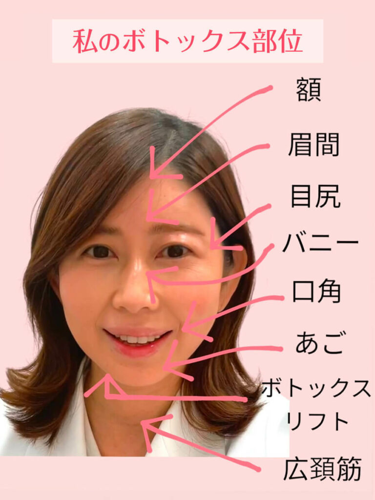 私のボトックス部位✨　（綺麗になれる最適部位を選びましょう！）..