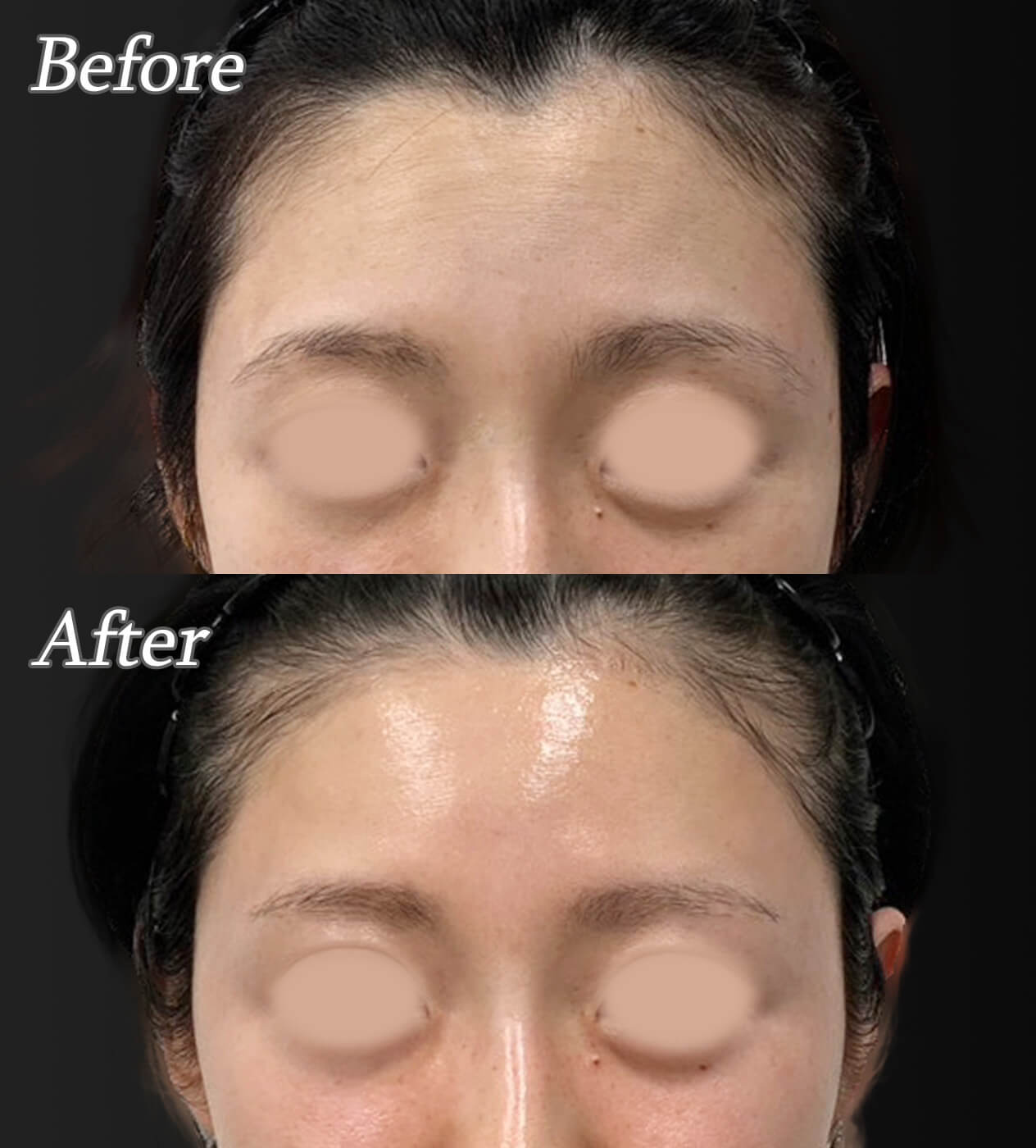 【額とこめかみ】ヒアルロン酸の威力