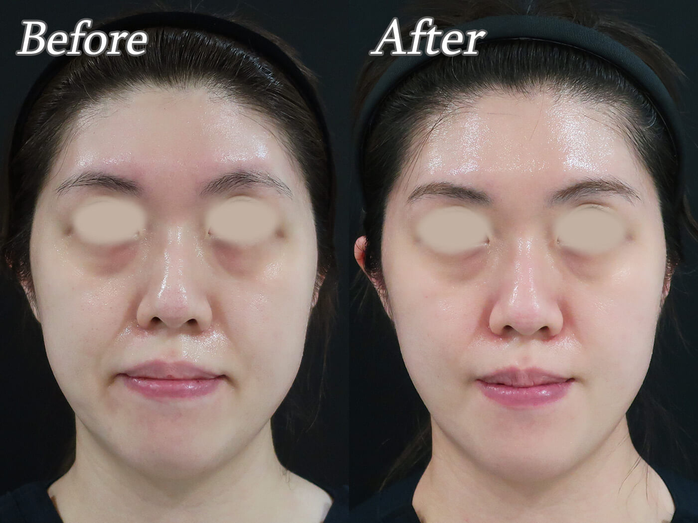 ボトックスの効果