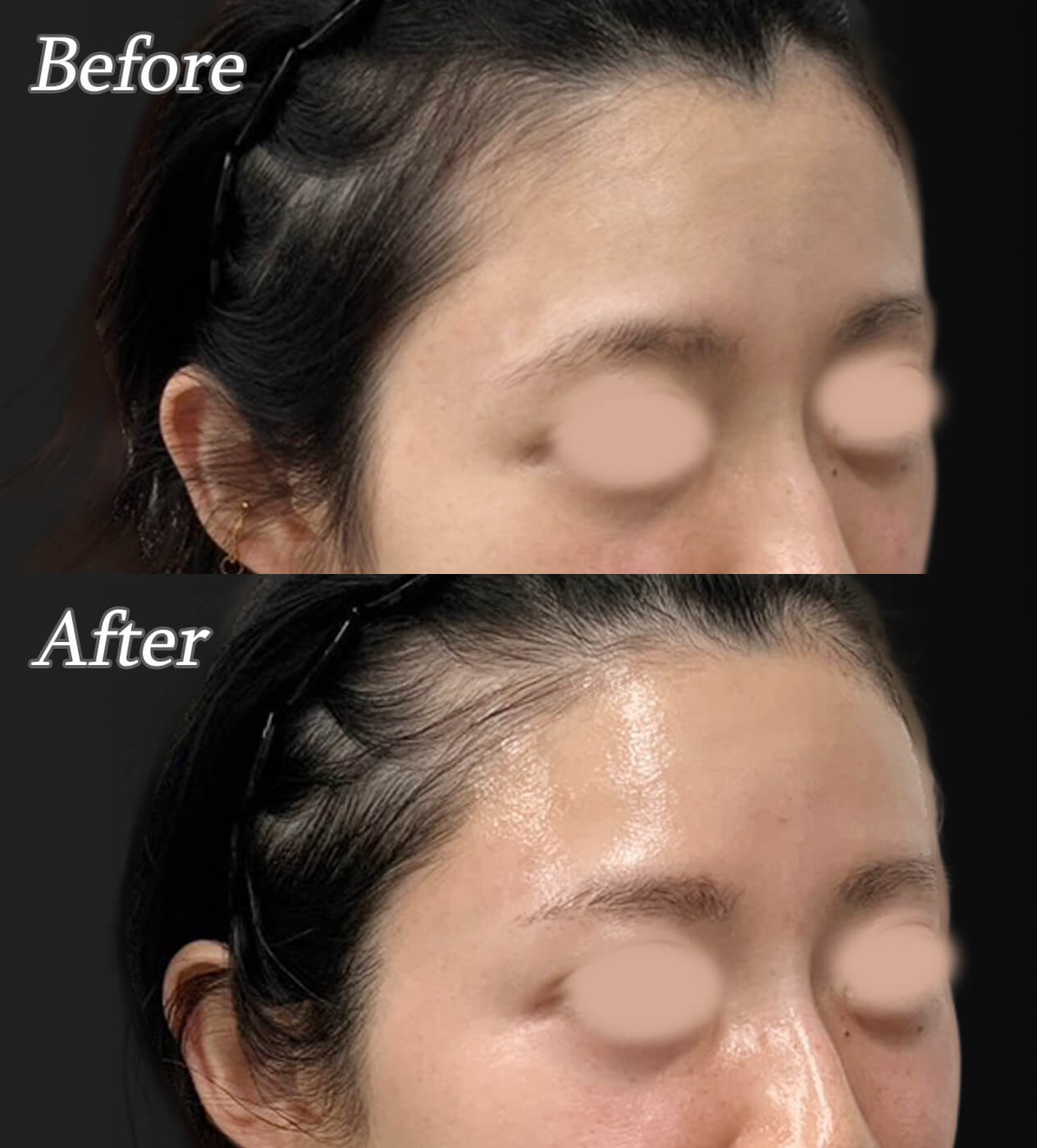 額・こめかみヒアルロン酸の症例