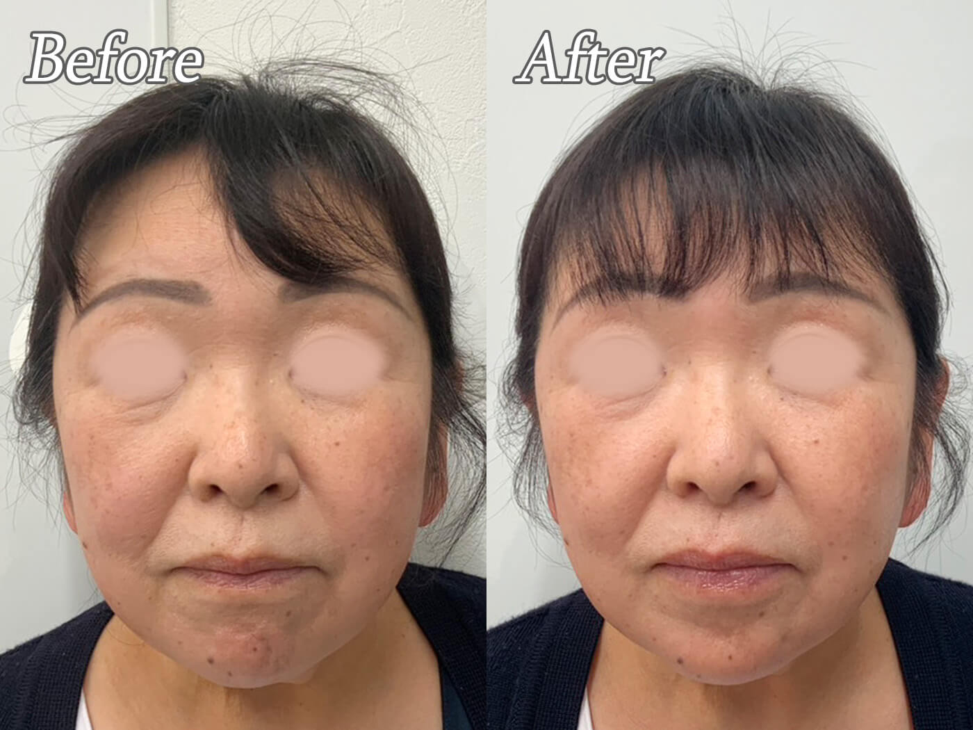 初めての【あごボトックス】　満足感のあるボトックス部位♪のご紹介..