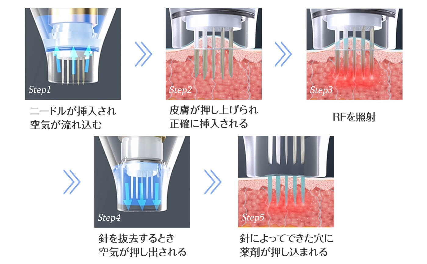 ポテンツァのドラッグデリバリーシステム