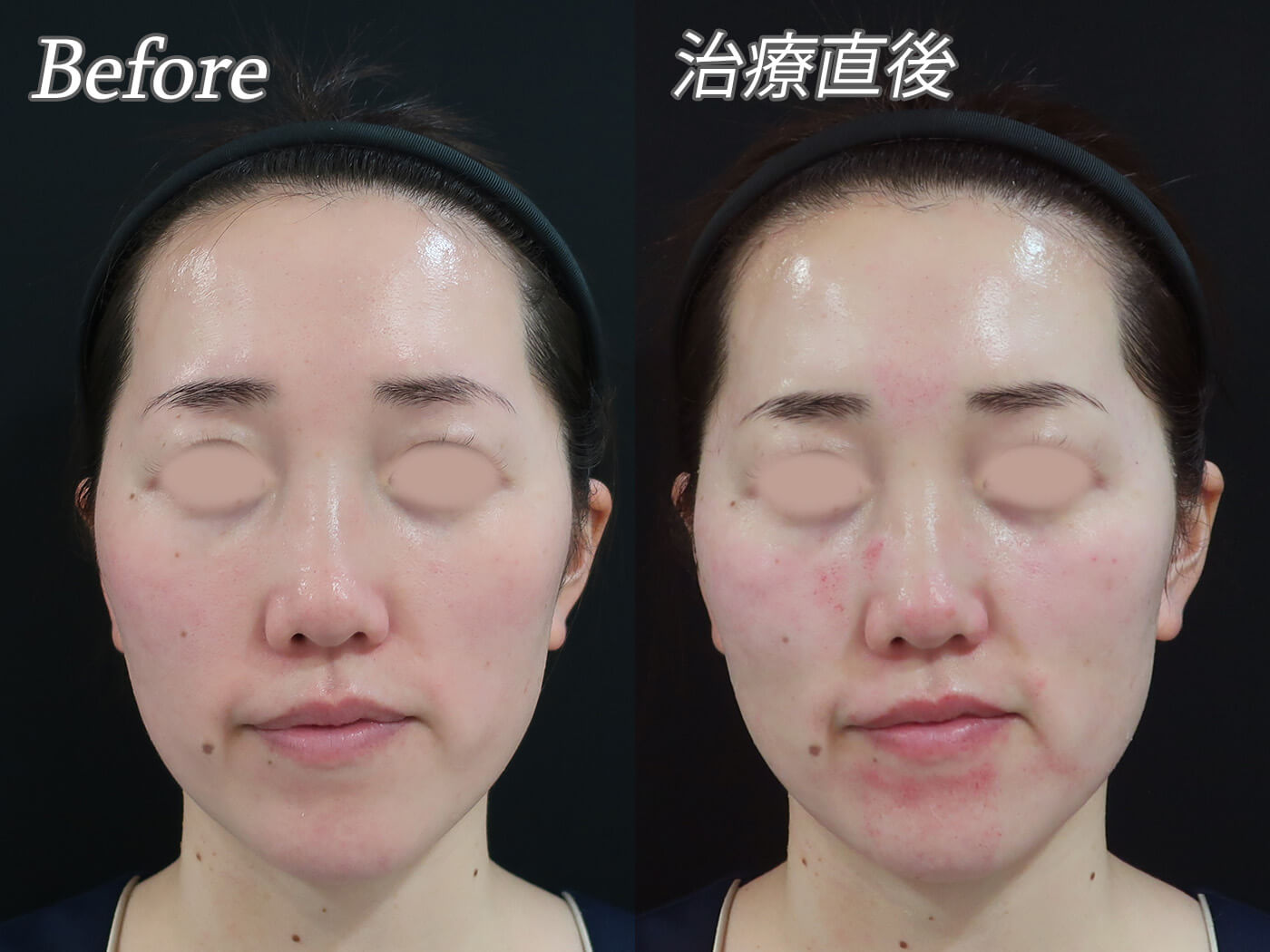 リジュラン　トーンアップブースター　ダーマペン リジュラン】美白もできるダーマペン用薬剤「TONE-UP BOOSTER