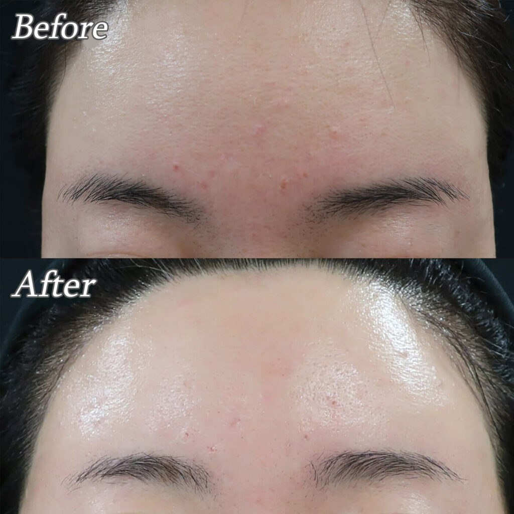 アグネスイボ治療