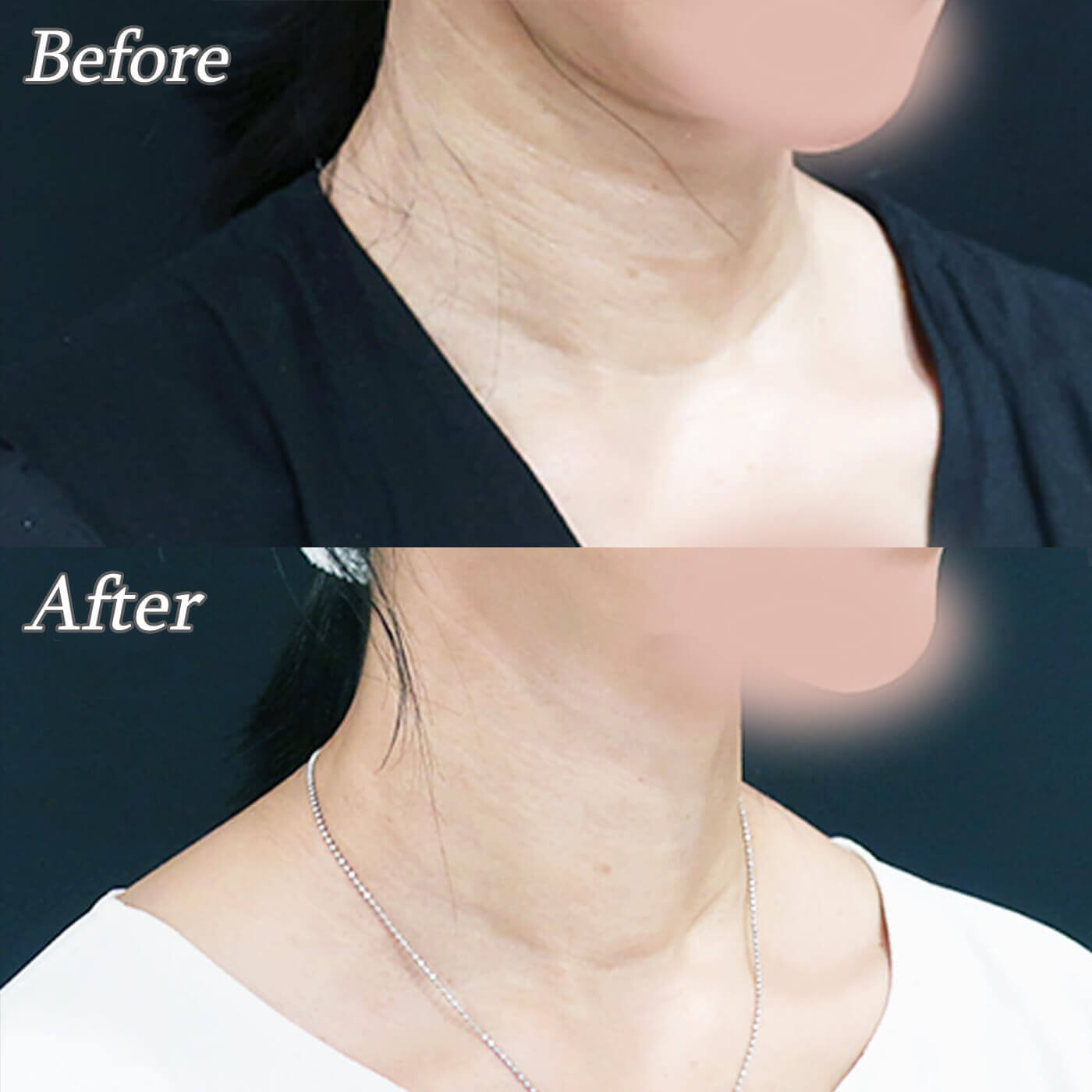 プロファイロの症例