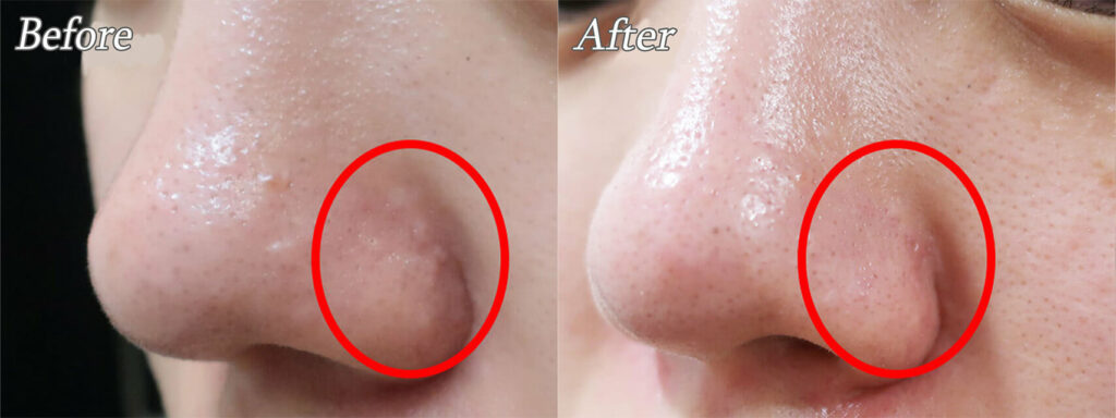 アグネスイボ治療