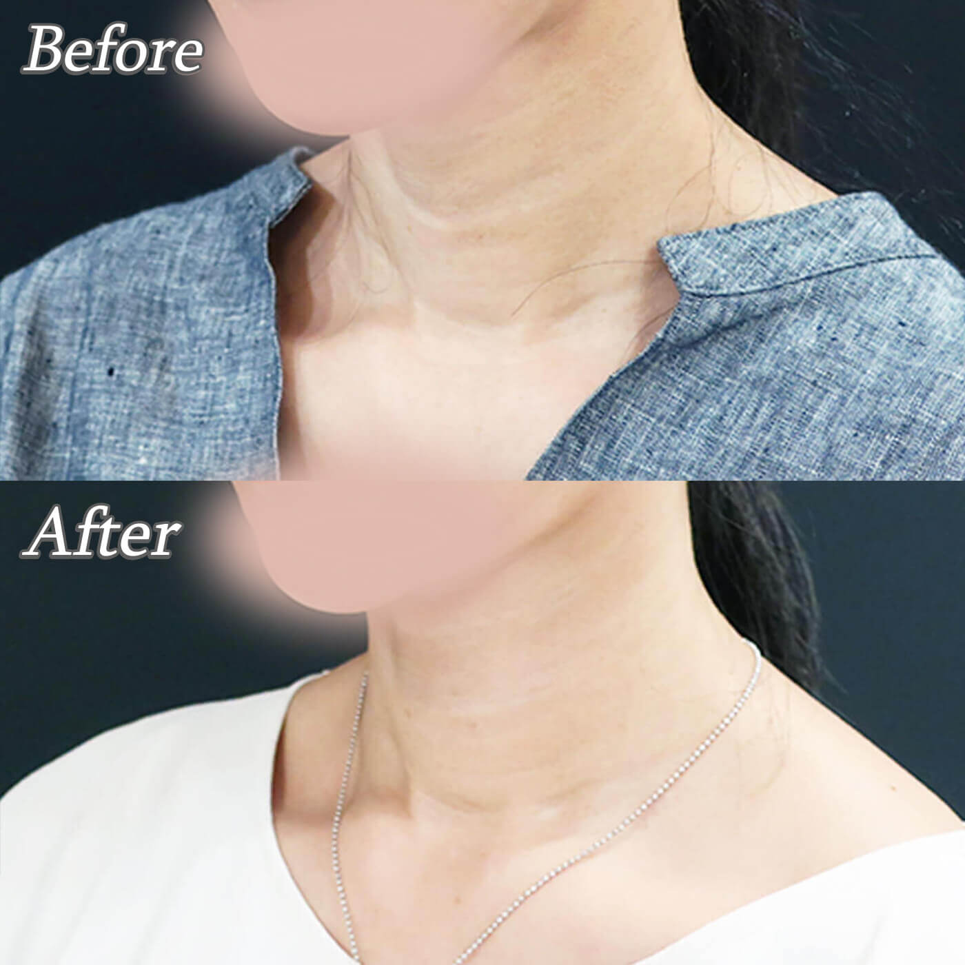 プロファイロの症例