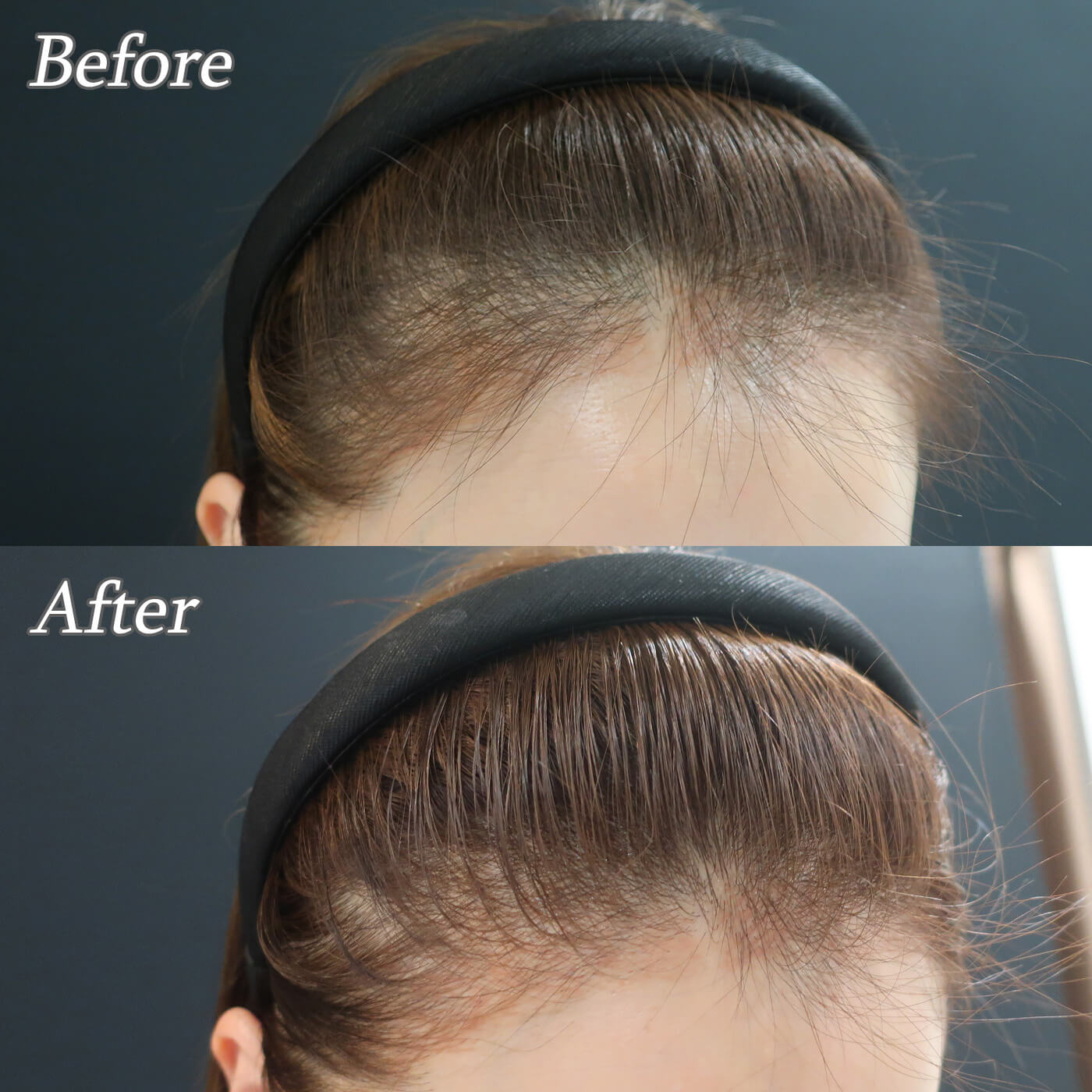 育毛エクソソーム水光注射