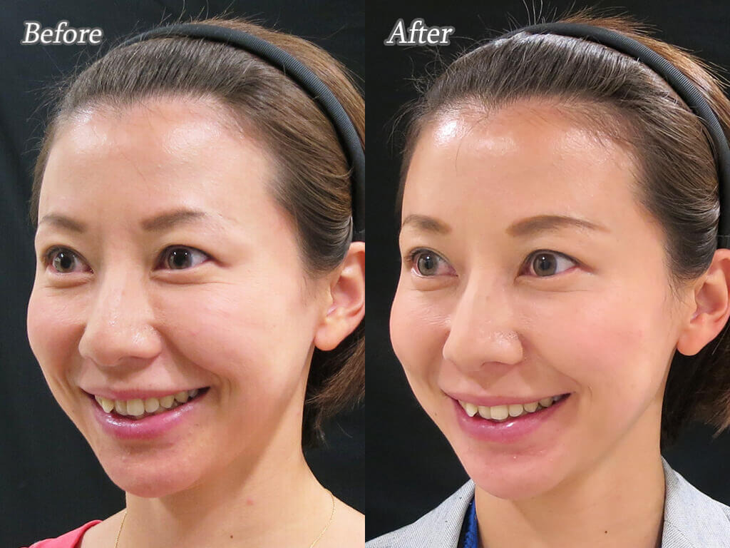 美しい方はより美しく〜ボトックス〜