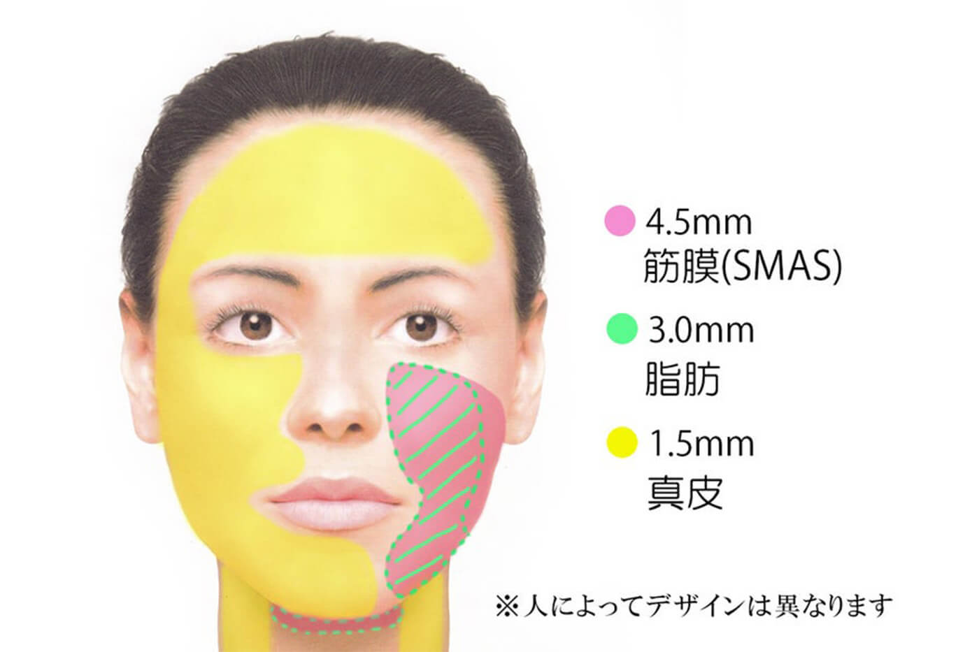 お顔のたるみにはHIFU！ - 東京 渋谷 美容皮膚科 マグノリア皮膚科