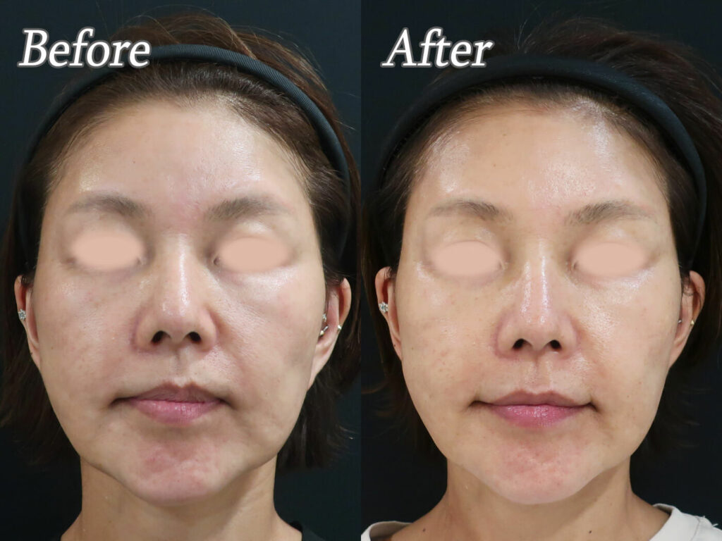 美肌治療でたるみも改善✨