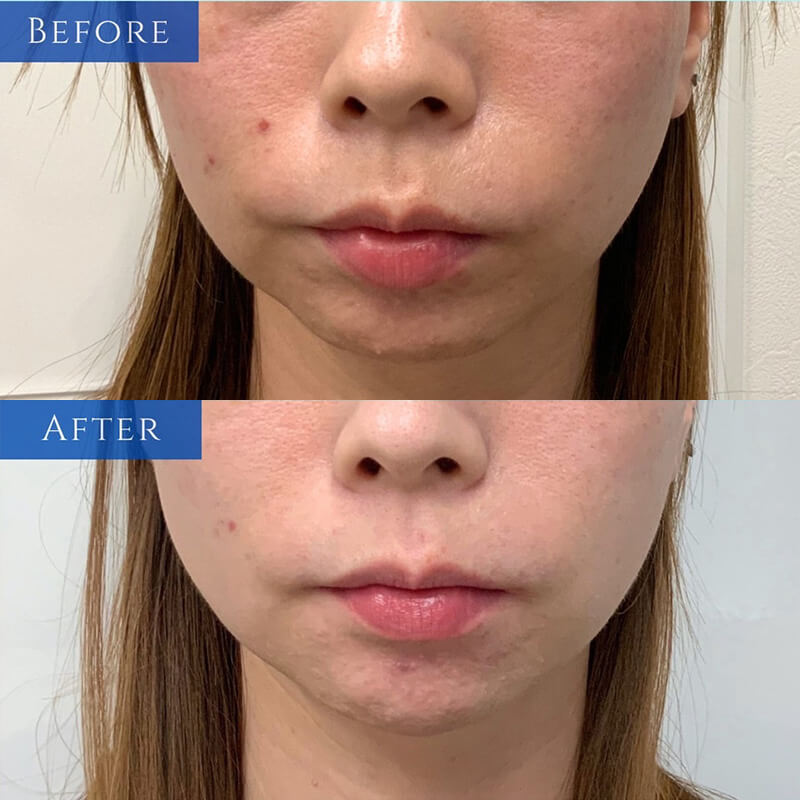 ヒアルロン酸の症例