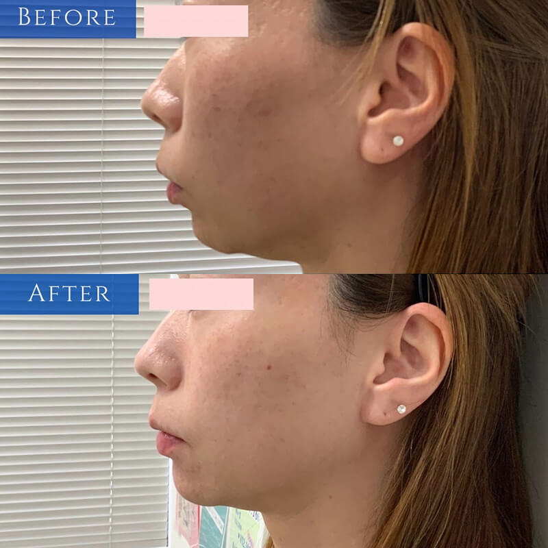 ヒアルロン酸の症例