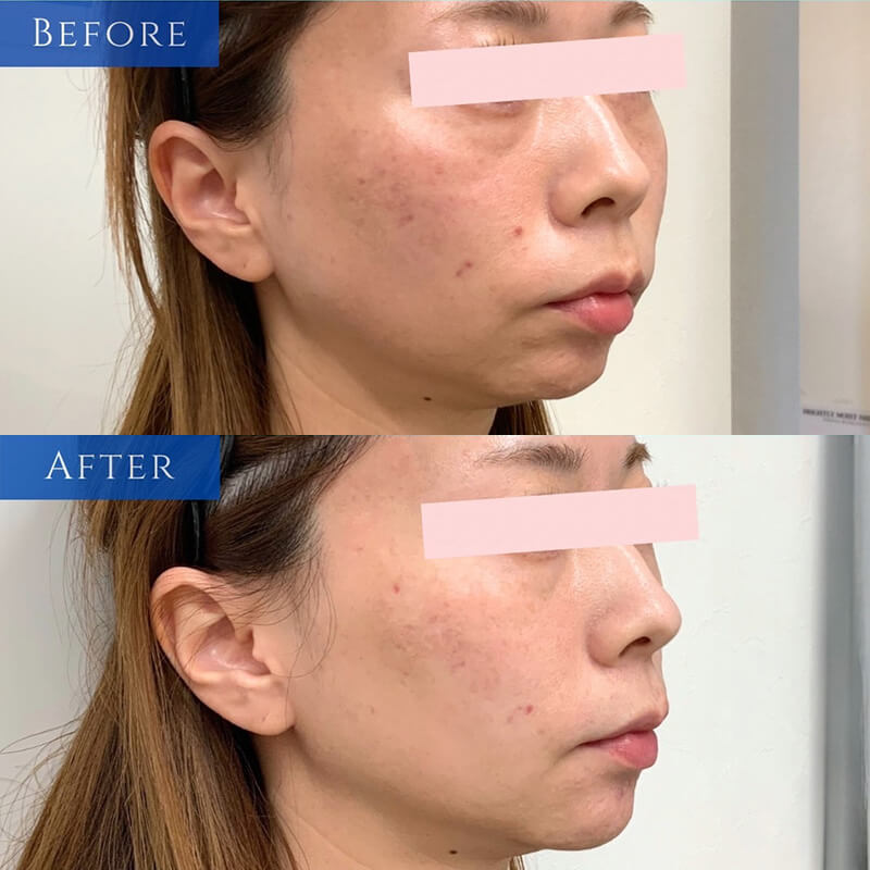 ヒアルロン酸の症例