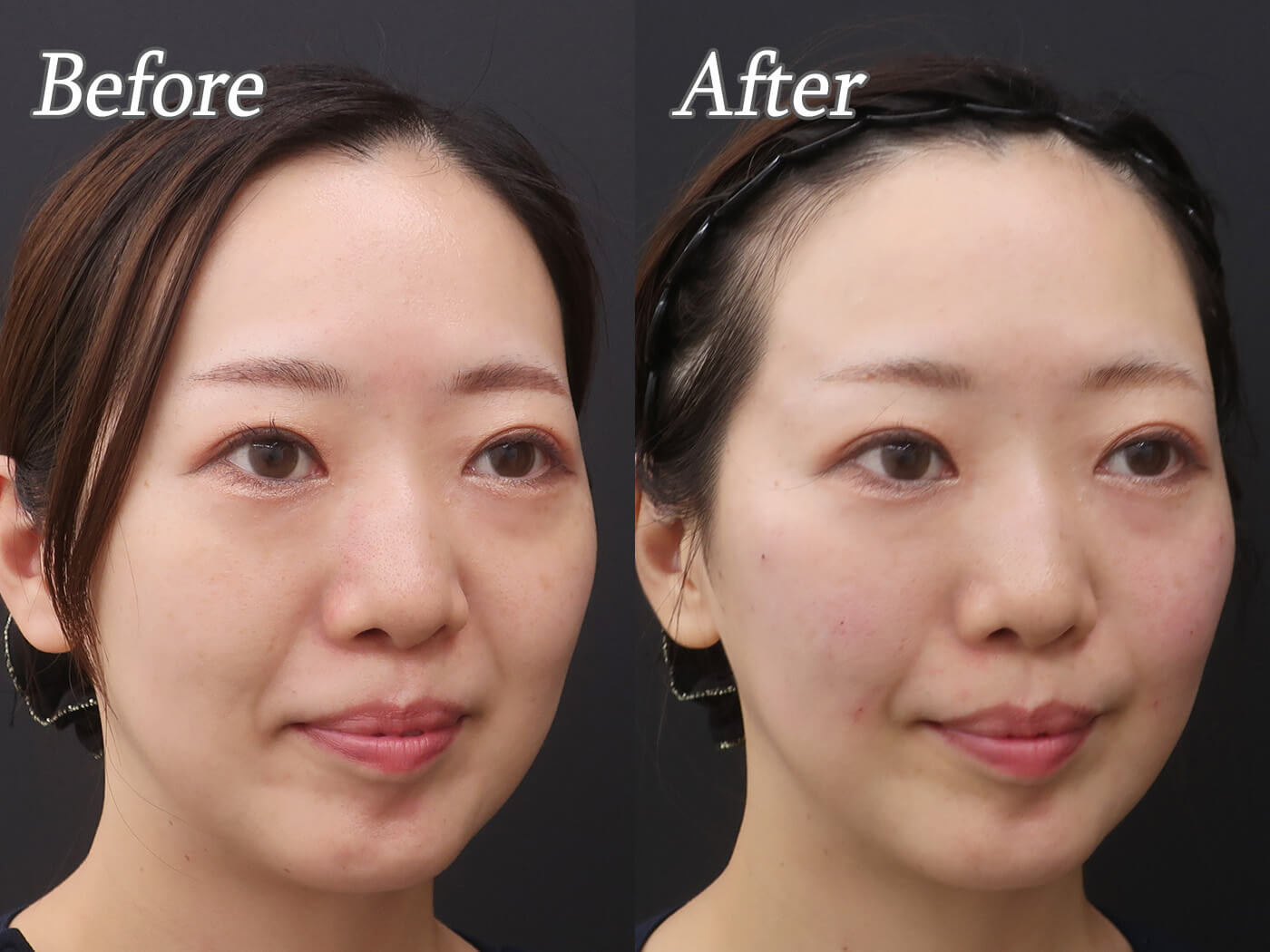 お顔のたるみを改善！〜ヒアルロン酸で土台をつくる〜