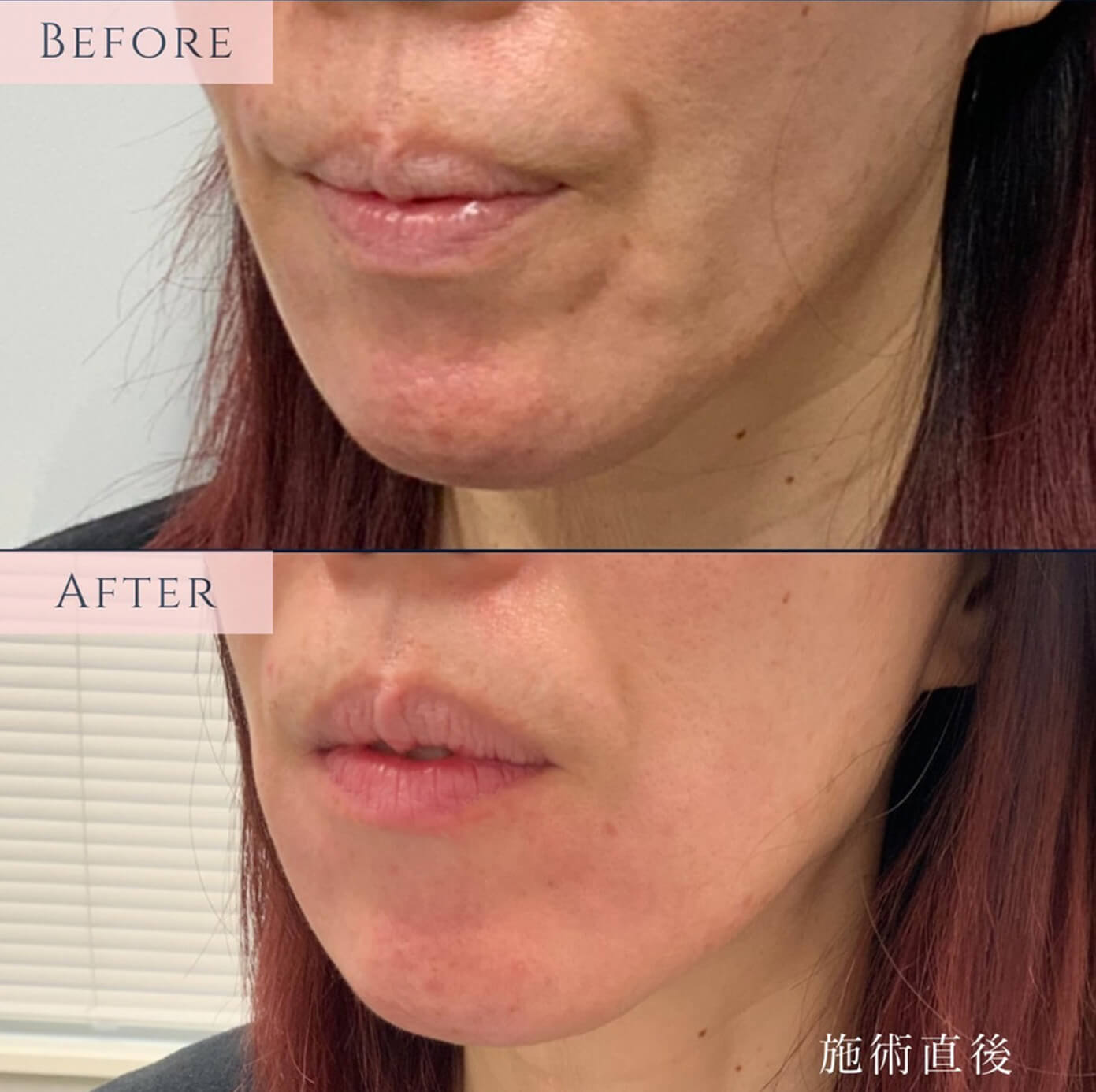 【後医は名医】は私の教訓　勇気を出してヒアルロニダーゼ！