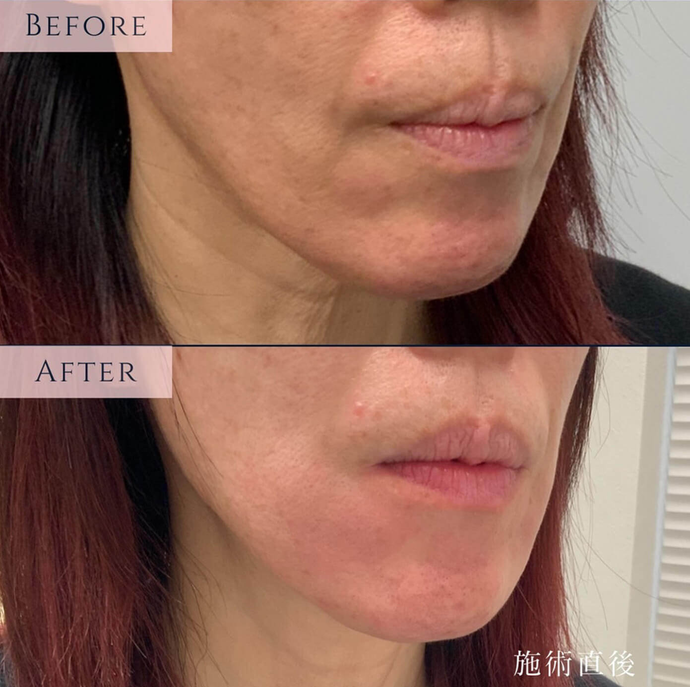 ヒアルロン酸溶解の症例_右