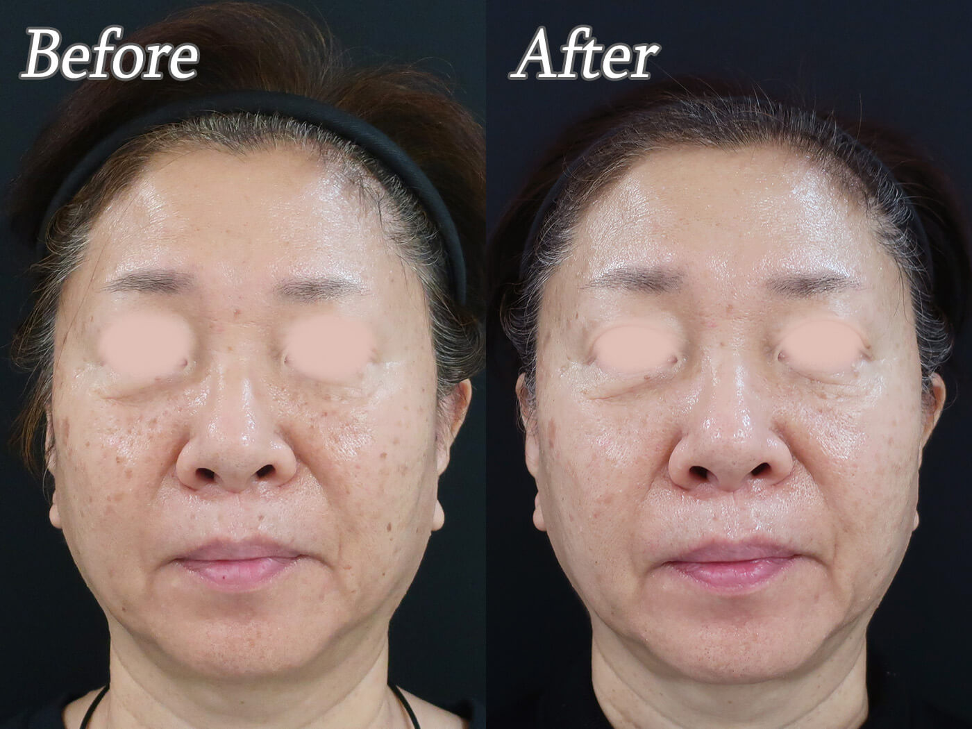 IPL(フォト)治療前後の症例写真05