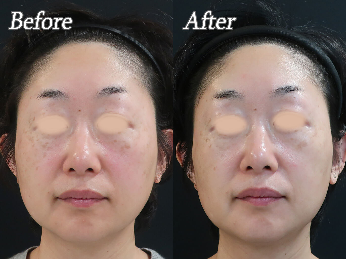 ルメッカの症例_正面