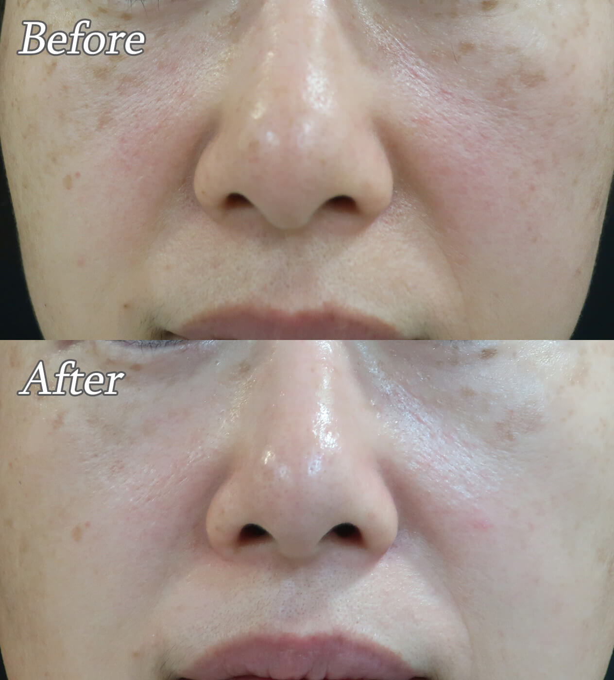 ルメッカの症例