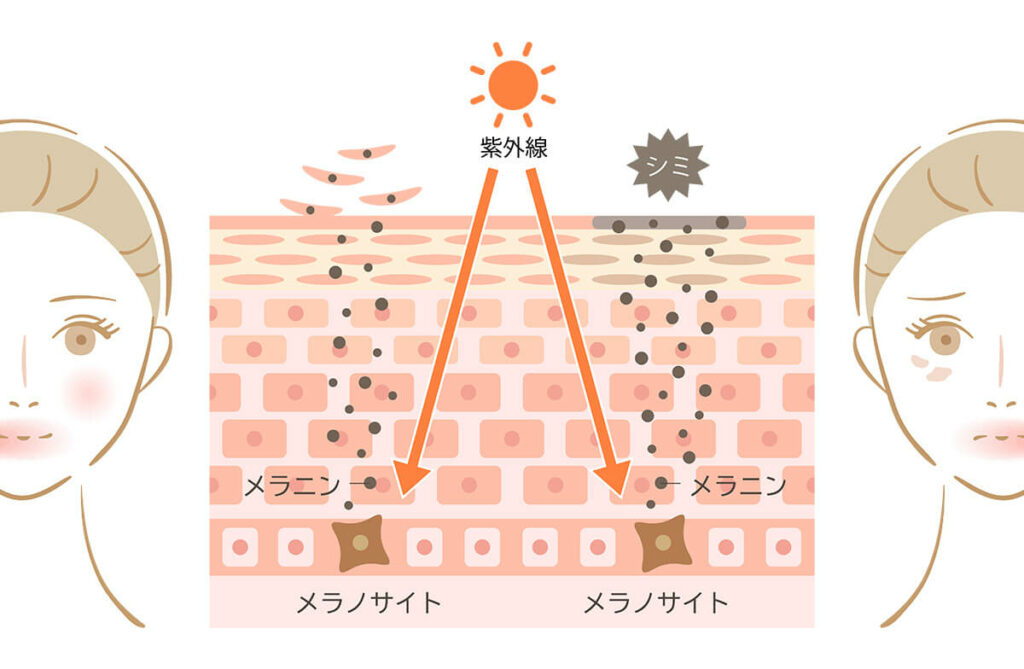 シミ治療はイボの予防になります！..