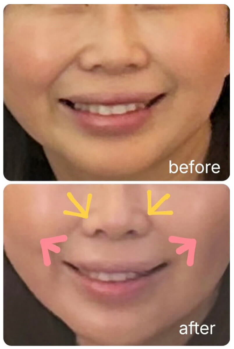 小鼻ボトックスの症例