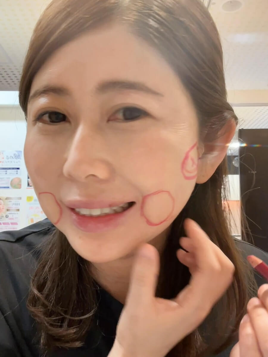 HIFUマーキング