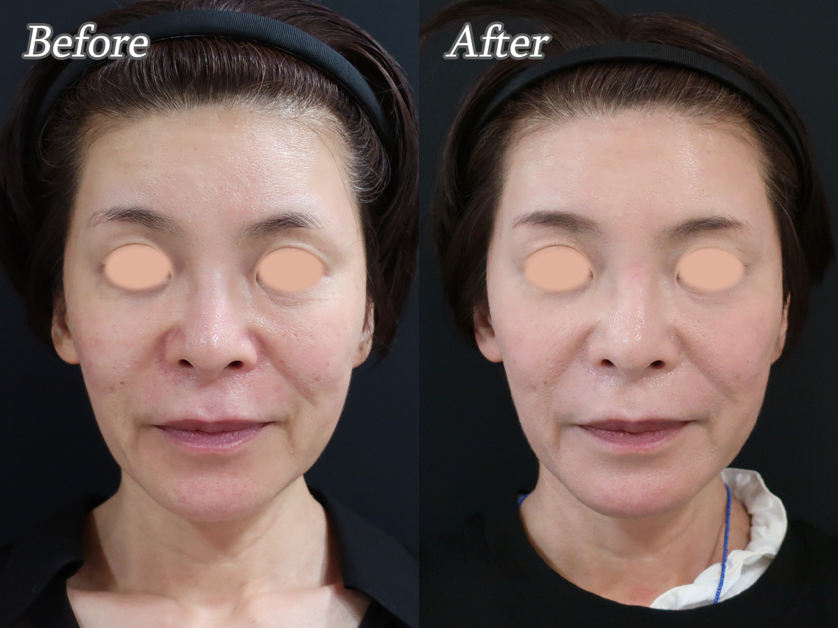 プロファイロ1回の効果