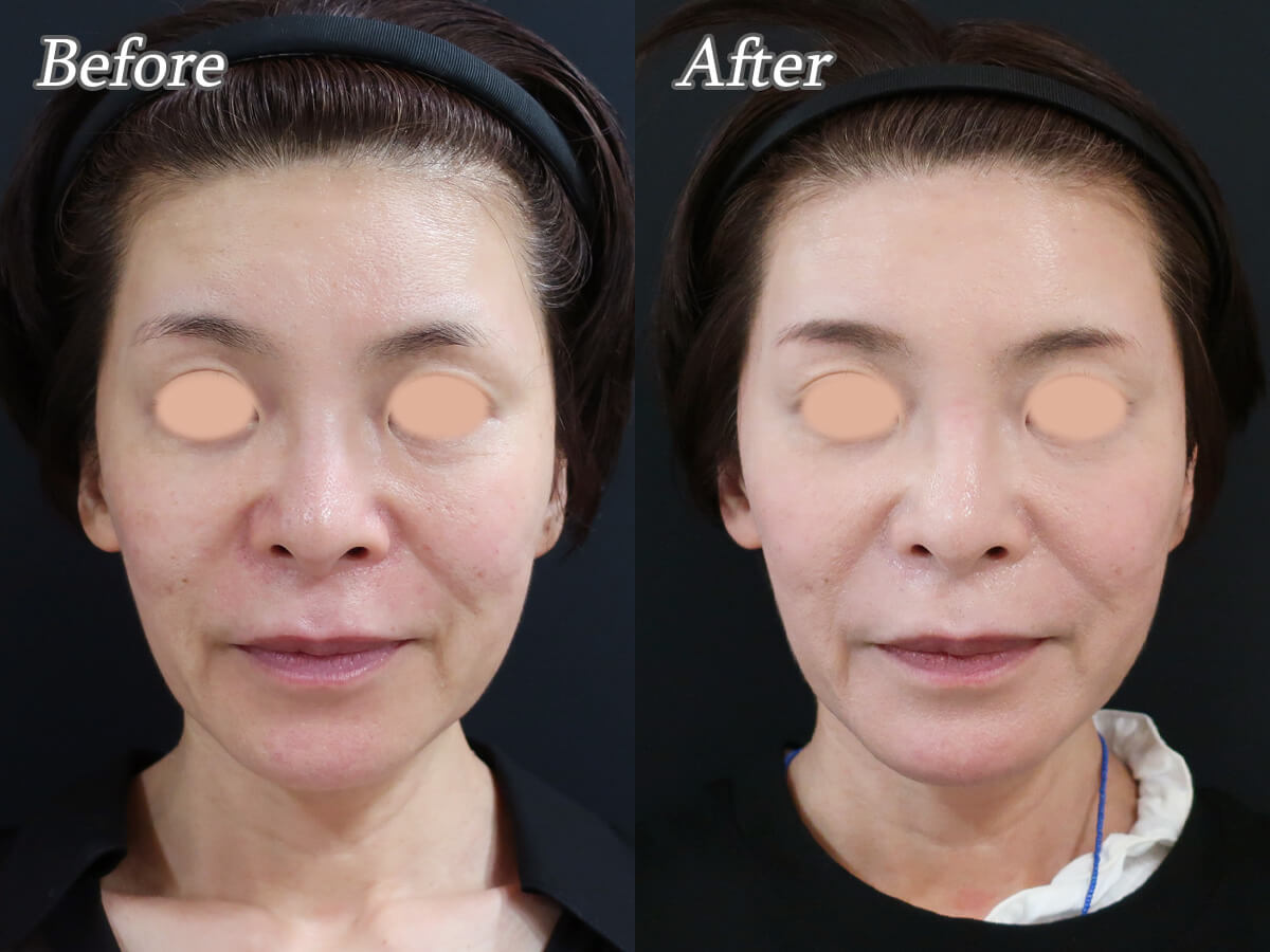 プロファイロ1回の効果..