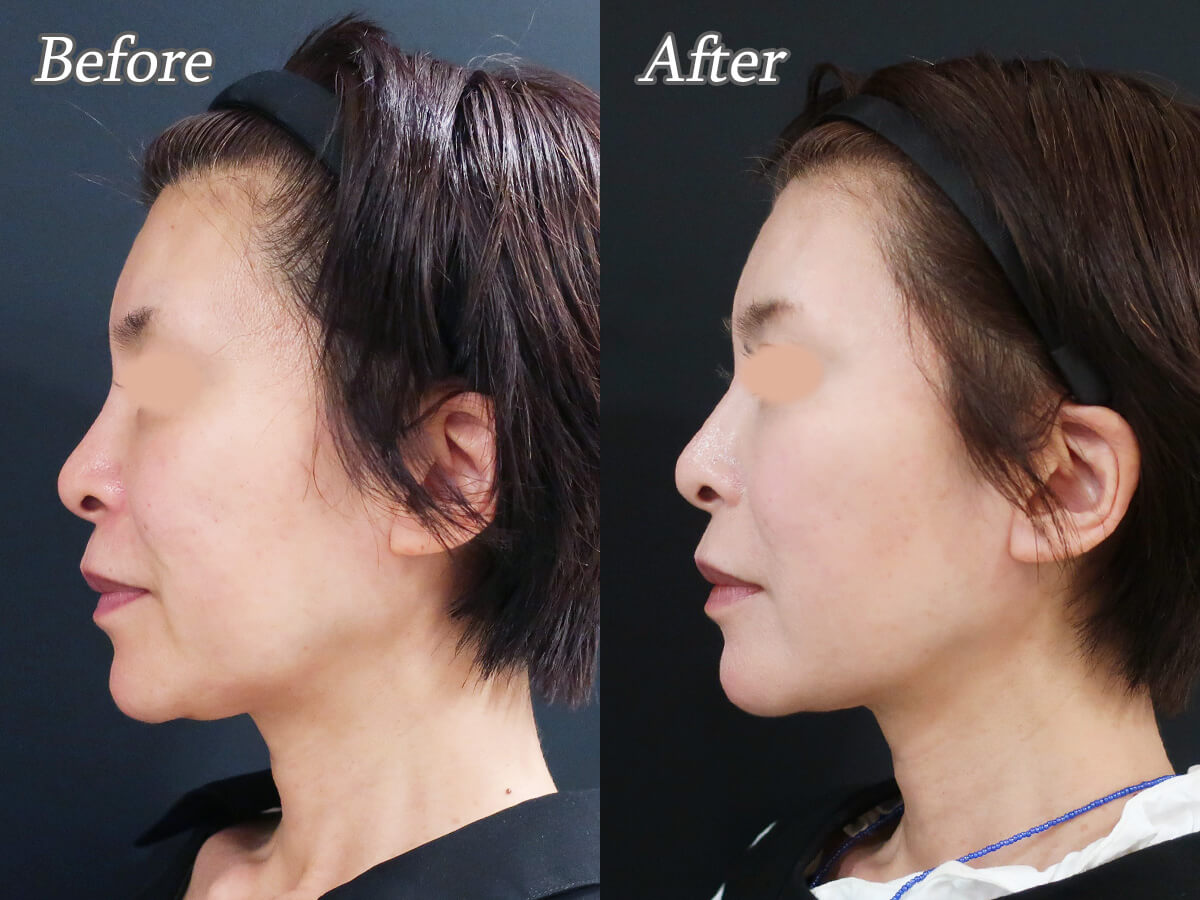 プロファイロの症例_横顔左