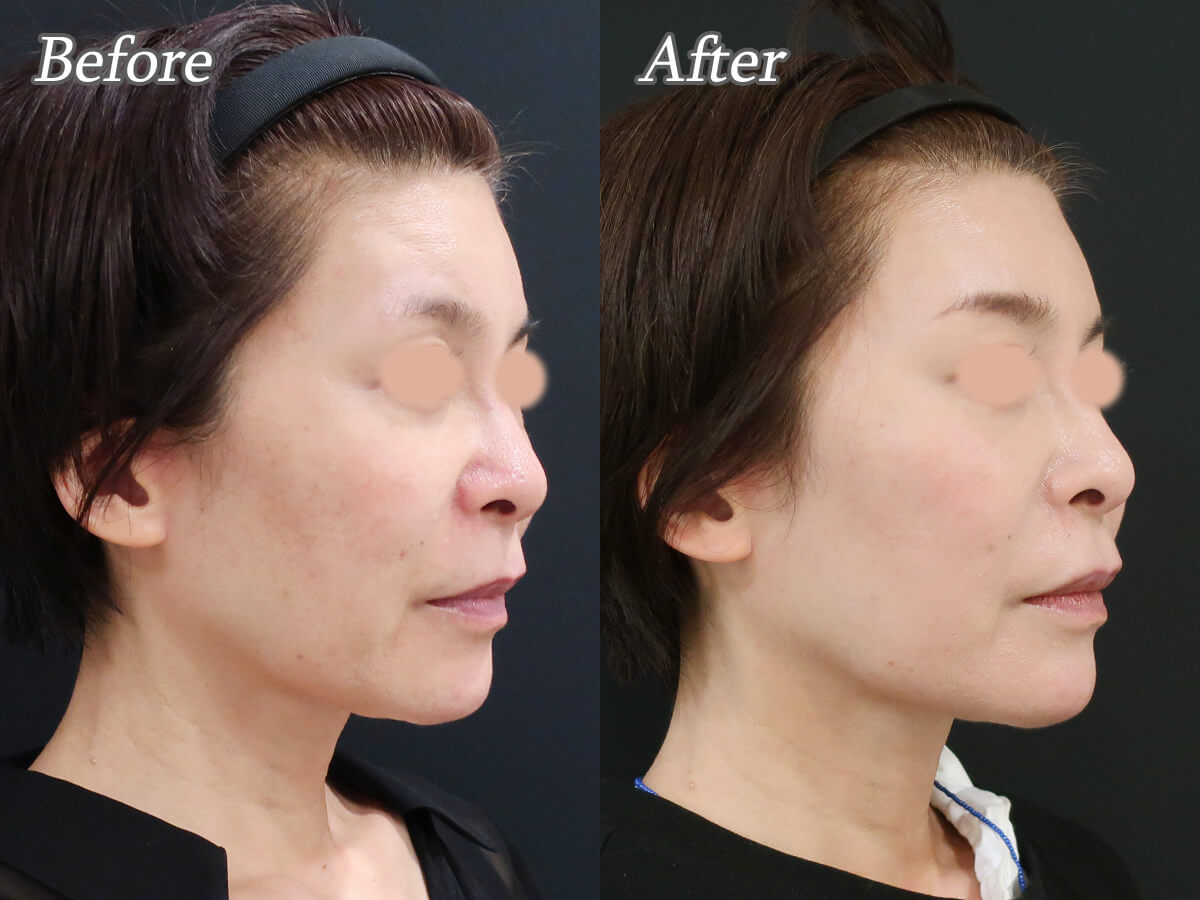 プロファイロの症例_右