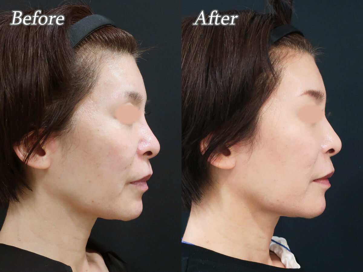 プロファイロの症例_横顔右