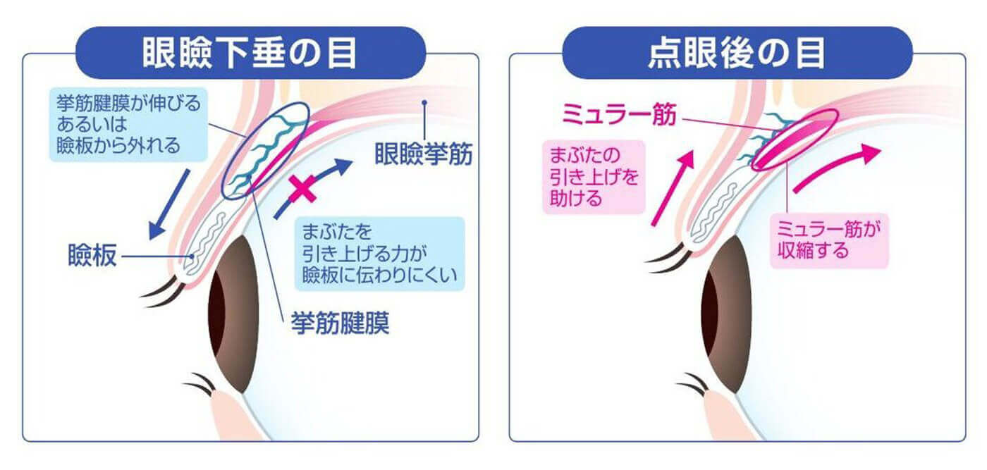 アップニークの機序