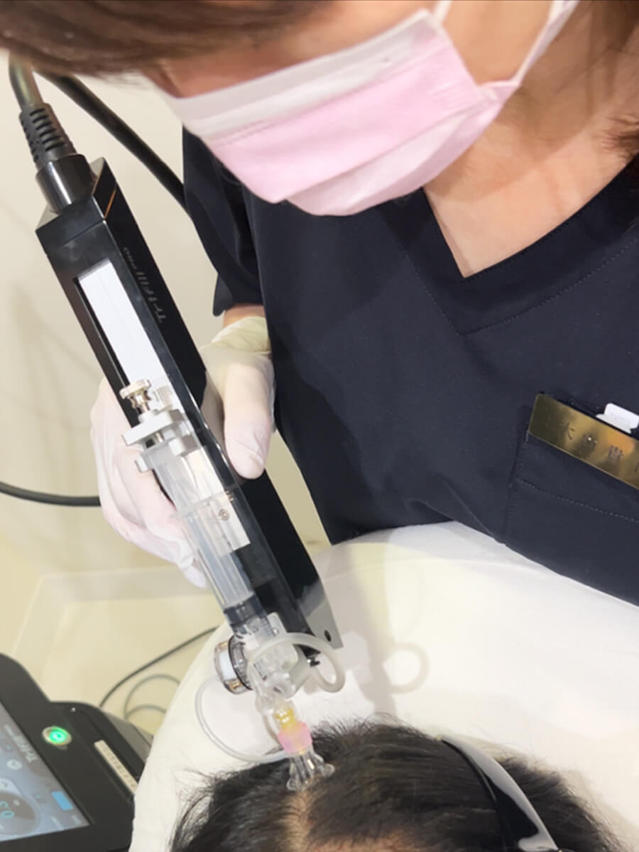 トライフィル治療の様子_頭皮