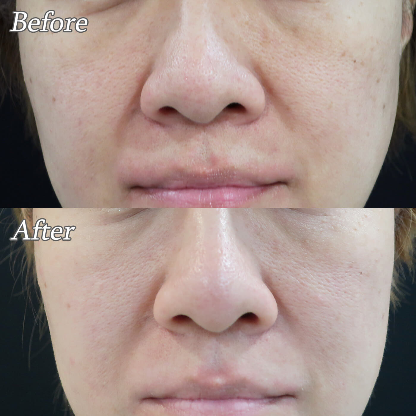 トライフィル美肌治療