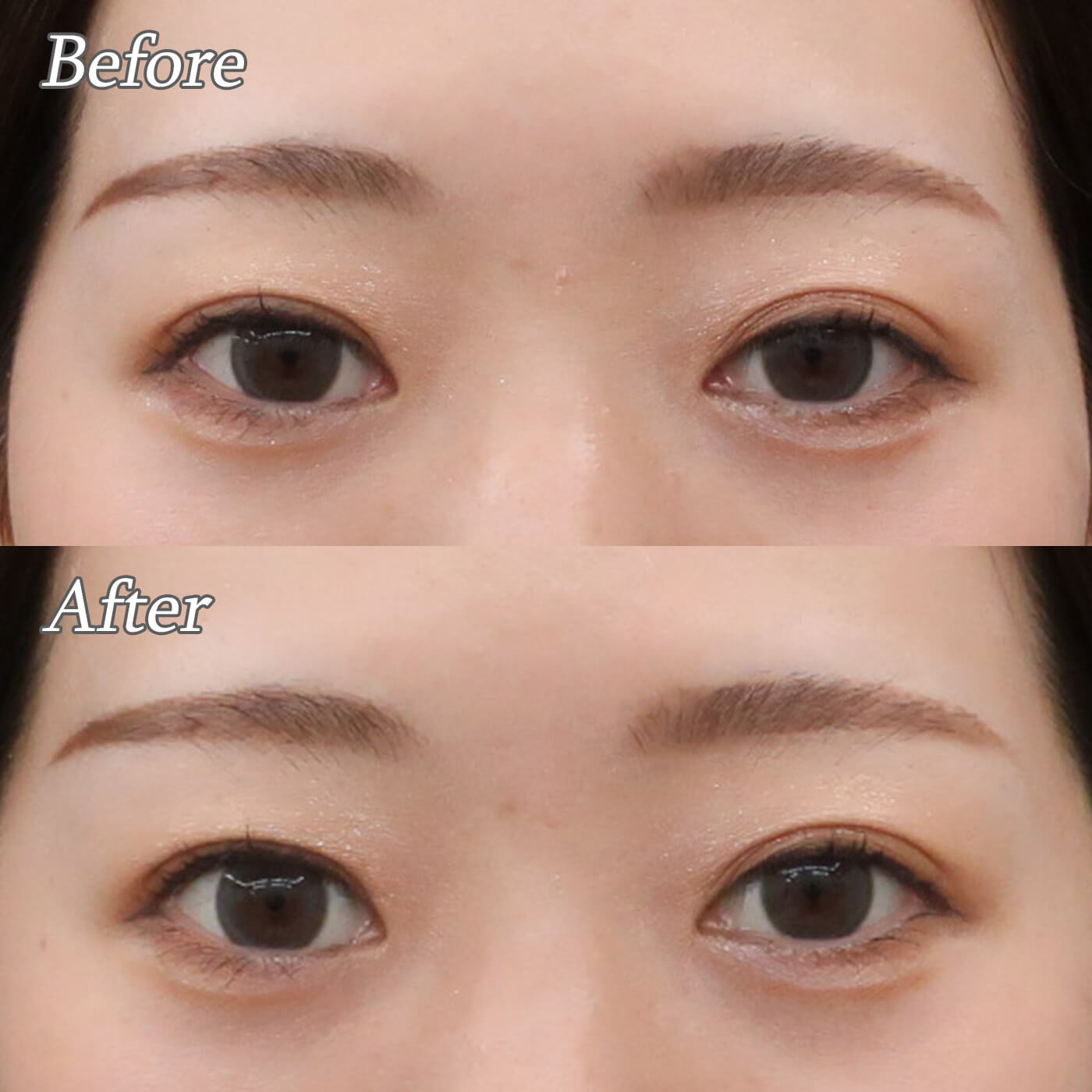 目元の印象は変わる?アップニーク(眼瞼下垂用点眼薬)を使ってみました👀
